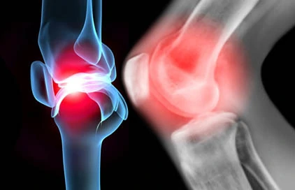 Saat Rasa Tidak Nyaman pada Sendi Terasa Sangat Mengganggu